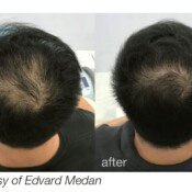 Hair loss treatment before and after.