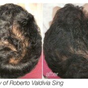 Hair loss before and after treatment.