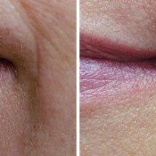 New Age Laser Clinic | Medical Spa & Laser Clinic | Veins Removal Veins Removal Before & After