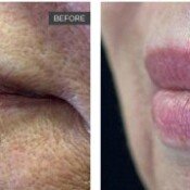 Lip Lase Before & After