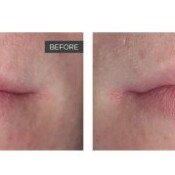 Lip Lase Before & After