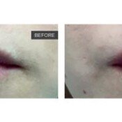 Lip Lase Before & After
