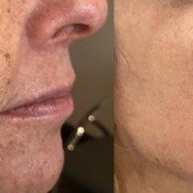 Lumecca Skin Rejuvenation Before & After