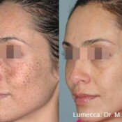 Lumecca Skin Rejuvenation Before & After