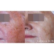 Lumecca Skin Rejuvenation Before & After