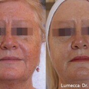 Lumecca Skin Rejuvenation Before & After