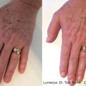 Lumecca Skin Rejuvenation Before & After