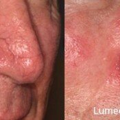 Lumecca Skin Rejuvenation Before & After