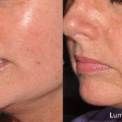 Lumecca Skin Rejuvenation Before & After