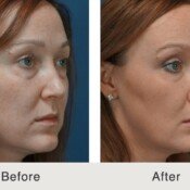 Lumecca Skin Rejuvenation Before & After