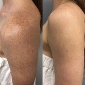Lumecca Skin Rejuvenation Before & After