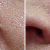 Scar Removal Before & After