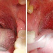 Snoring Treatment Before & After