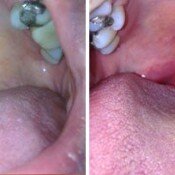 Snoring Treatment Before & After