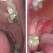 Snoring Treatment Before & After