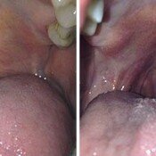Snoring Treatment Before & After
