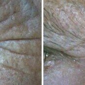 Close-up of wrinkles before and after treatment.