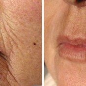 Before and after wrinkles treatment on a woman's face.