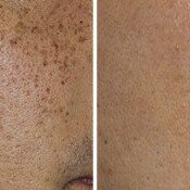 Lumecca Skin Rejuvenation Before & After