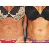 Forma Before & After