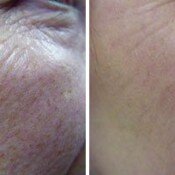 Before and after skin treatment results.