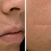 Scar Removal Before & After