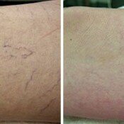 New Age Laser Clinic | Medical Spa & Laser Clinic | Veins Removal Veins Removal Before & After