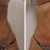 Before and after skin tightening treatment.