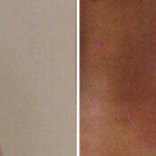 Before and after treatment of varicose veins.