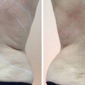 Before and after treatment of the back.